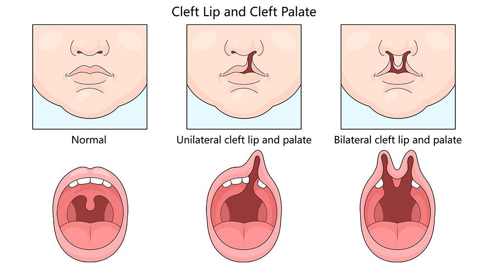 Cleft lip and palate surgery in Orland Park